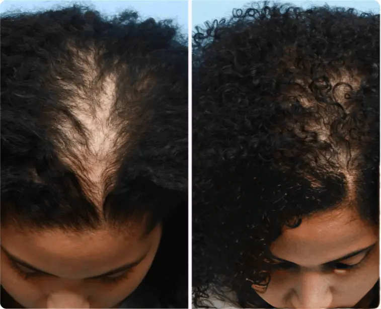 HairLux Follicle Activator